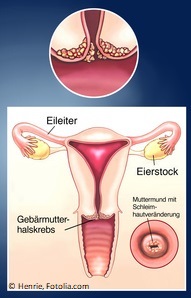 Abbildung Gebärmutterhalskrebs