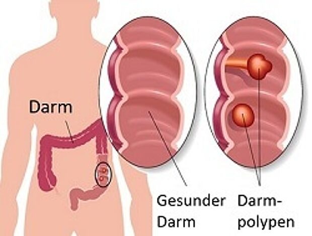 Anatomische Darstellung eines gesunden Darmabschnittes und eines Abschnittes mit Darmpolypen