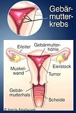 Darstellung Gebärmutterkörperkrebs