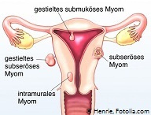 Anatomische Darstellung von Myomen