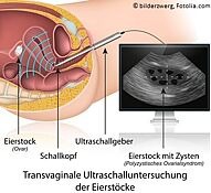 Transvaginale Ultraschalluntersuchung der Eierstöcke