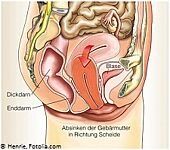 Anatomische Darstellung einer Gebärmuttersenkung